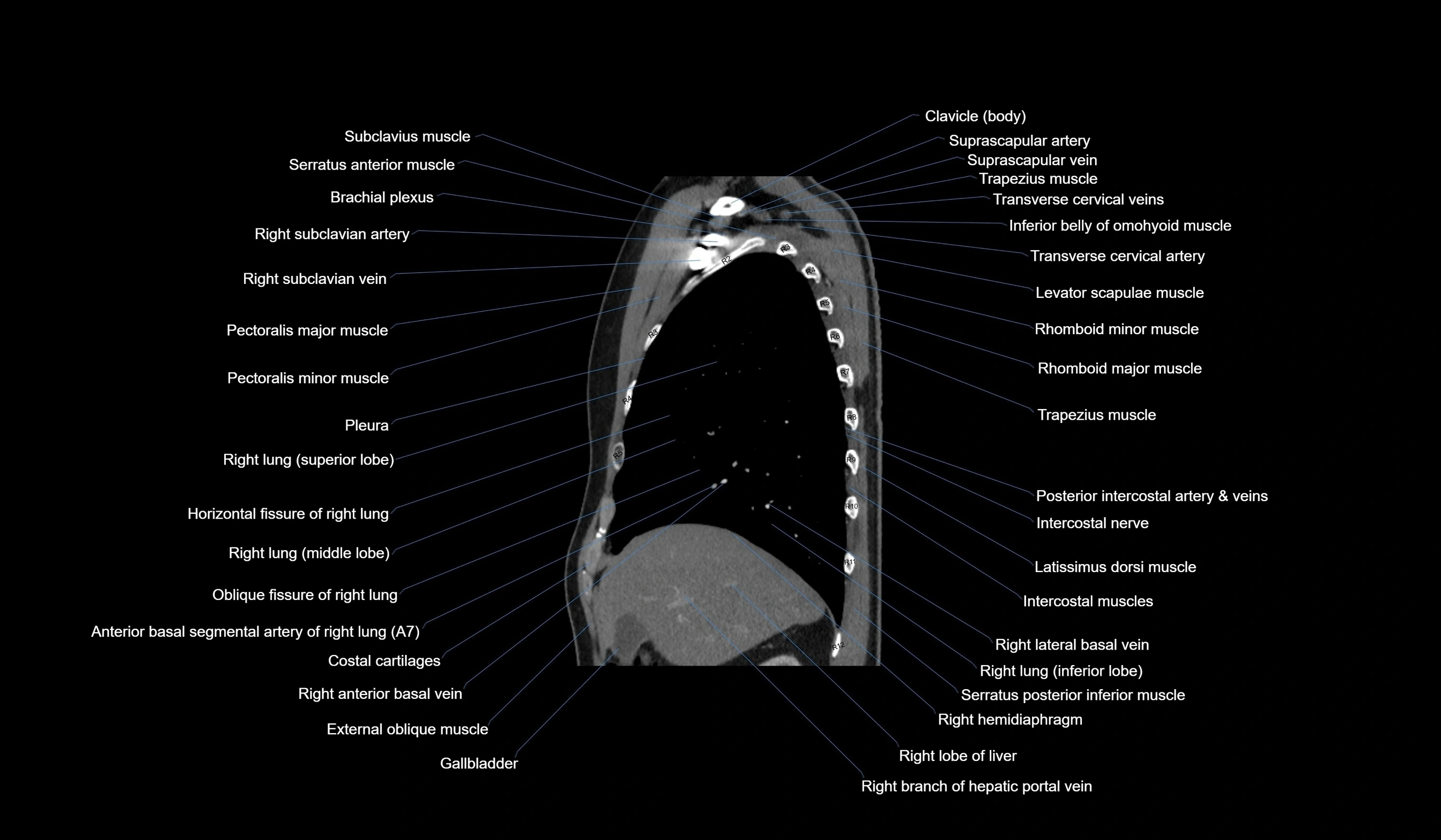 CT chest (thorax) labelled sagittal cross sectional anatomy radiology image-00039.webp